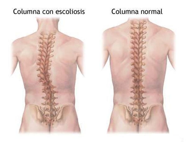 Escoliosis del adolescente y su tratamiento mediante Osteopatía, osteopatía y Pilates