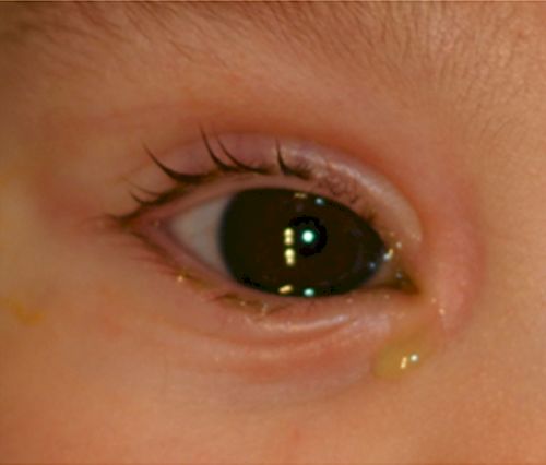 Obstrucción del canal nasolagrimal en bebés biomedic vigo